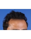 After Hair Transplant&nbsp;2 Sessions (Areas)